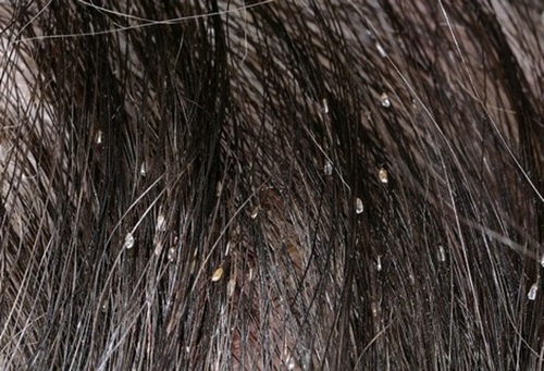 Гниды на волосах