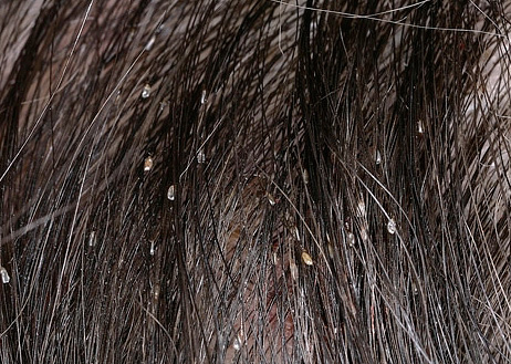 Гниды на волосах фото