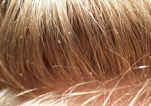 гниды на волосах у ребенка
