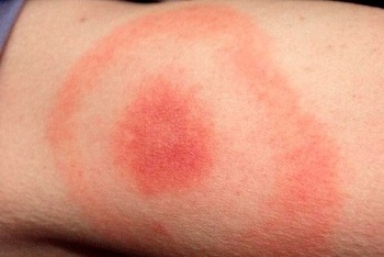 Красные круги от укуса клеща признак инфекции